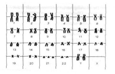 Chromosomen patroon van een jongen met Down